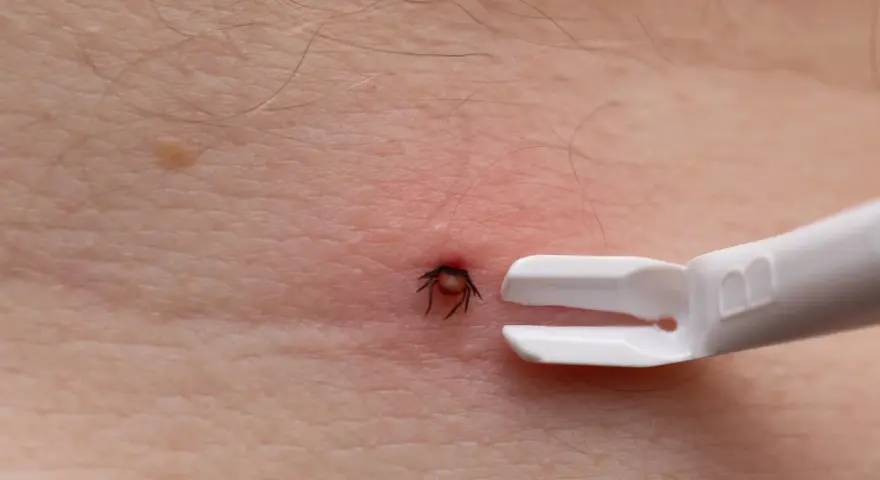 Urwany kleszcz w skórze? Rozpoznaj resztki i działaj krok po kroku